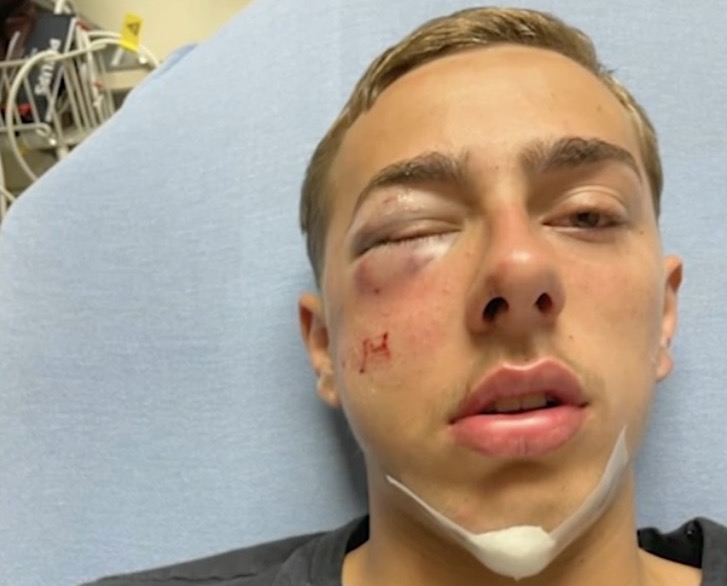 15-year-old Jayden after allegedly being attacked by a DSP trooper (WPVI screenshot)